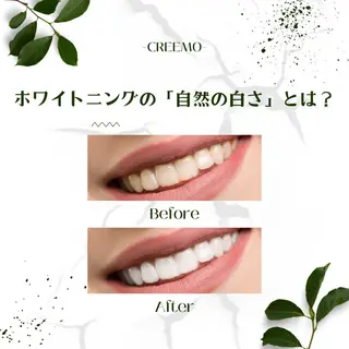 歯のホワイトニング HARU南浦和のその他イメージ