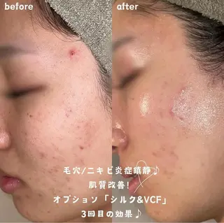 【ハーブピーリング/毛穴洗浄】NA skin 川崎店〜ニキビ・毛穴専門店〜所属・NAskin川崎 皆川のエステ・リラクイメージ