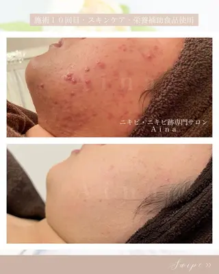 セミロング メンズ キッズ ネイル マツエク・マツパ アイブロウ ニキビ跡専門サロン Ainaのエステ・リラクイメージ