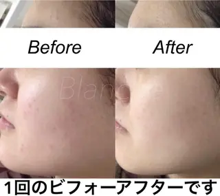 セミロング カラー パーマ ヘアアレンジ キッズ ネイル マツエク・マツパ 都度払い肌質改善 &脱毛Blancheのエステ・リラクイメージ