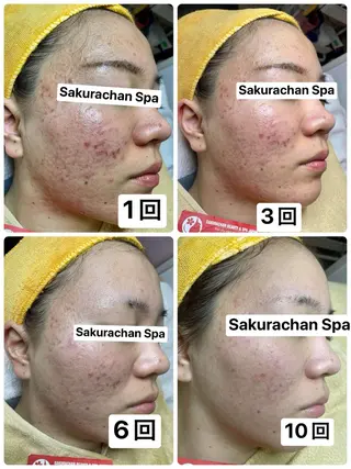 ニキビ、痩身、脱毛、 サクラチャンスパのエステ・リラクイメージ