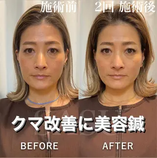 アイブロウ 即小顔♥️美容鍼× ハーブピーリングのその他イメージ