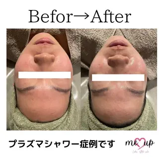 Meupニキビ専門店 背中/ハーブ/ララのその他イメージ