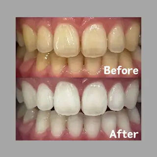 Kaula所属・Kaula ホワイトニング耳ツボのその他イメージ