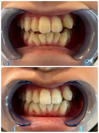 歯のセルフホワイトニング専門店GLOW（グロウ）所属・東区香椎歯のセルフホ ワイトニングGLOWのその他イメージ