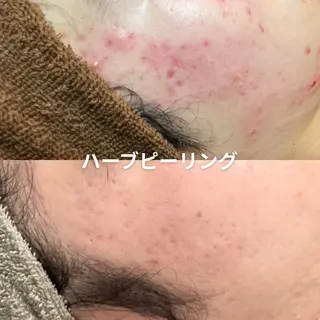 EST BEAUTY所属・顔専門ワックス脱毛/ ハーブピーリングのエステ・リラクイメージ