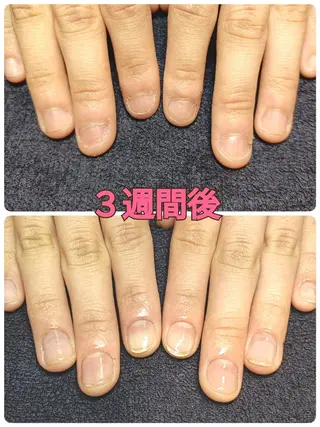 ネイル 深爪矯正/爪育成ケア manie nailのネイルデザイン