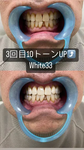 メンズ セルフホワイトニング White33大名のその他イメージ