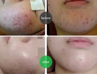 ☺ハーブピール💕 ソフィアカロン💖のエステ・リラクイメージ