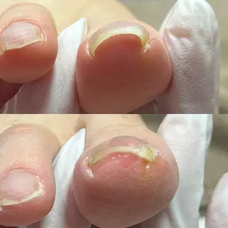 自爪育成・巻き爪 補正講師　津蔵のネイルデザイン