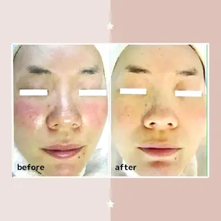 ニキビケア&ニキビ跡 レゾン京橋店 のエステ・リラクイメージ