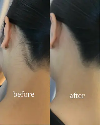 うなじ脱毛/美肌脱毛 LABELのエステ・リラクイメージ