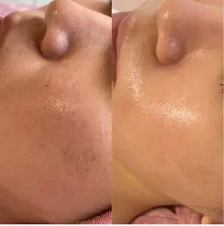 最速小顔・肌質管理 ❣️エスポワールのエステ・リラクイメージ