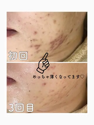 ロング カラー パーマ ヘアアレンジ メンズ キッズ ネイル マツエク・マツパ ニキビ&跡改善サロン オーナー光木のエステ・リラクイメージ