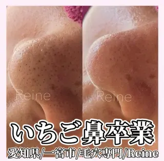 Reine BeautySalon所属・毛穴/シミ肝斑/脱毛 横山梨里のエステ・リラクイメージ