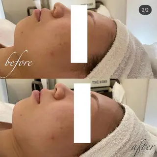 毛穴/ピーリング ララピール/POLAのエステ・リラクイメージ