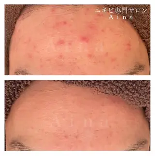 セミロング カラー パーマ ヘアアレンジ メンズ キッズ ネイル マツエク・マツパ アイブロウ ニキビ跡専門サロン Ainaのエステ・リラクイメージ