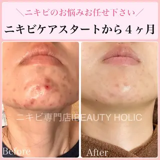 ニキビ・ 肌荒れ専門店のエステ・リラクイメージ