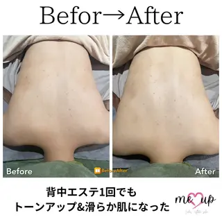 Meupニキビ専門店 背中/ハーブ/ララのその他イメージ