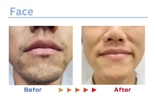 セルフ脱毛/美尻イス キングスサロン熊本のエステ・リラクイメージ