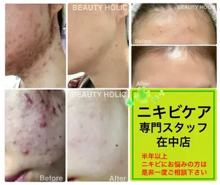 ニキビ・ 肌荒れ専門店のエステ・リラクイメージ