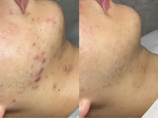 ニキビケア・毛穴洗浄専門店　Drop所属・ニキビケア＆毛穴洗浄 Rikoのエステ・リラクイメージ