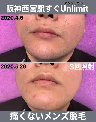 メンズ 脱毛＆エステサロン【アンリミット】所属・森谷 莉美のエステ・リラクイメージ