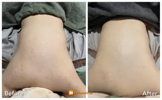 Meupニキビ専門店 背中/ハーブ/ララのその他イメージ