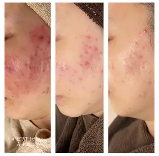 セミロング パーマ ヘアアレンジ メンズ キッズ ネイル マツエク・マツパ アイブロウ ニキビ跡専門サロン Ainaのエステ・リラクイメージ