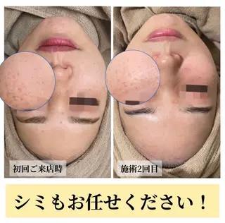 ハーブピーリング・毛穴ケア専門サロンSalon de LENA所属・ハーブピーリング 毛穴専門店/栄のエステ・リラクイメージ