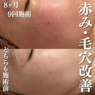 6万人の美肌実績🔥 最短ニキビ改善のエステ・リラクイメージ