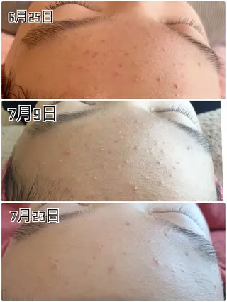 【リベルハーブピーリング認定店】敏感肌・美白脱毛専門店Dione立川店所属・Dione 立川店のエステ・リラクイメージ