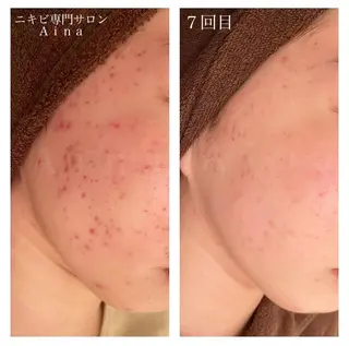 セミロング パーマ ヘアアレンジ メンズ キッズ ネイル マツエク・マツパ アイブロウ ニキビ跡専門サロン Ainaのエステ・リラクイメージ