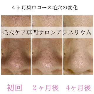 毛穴ケア専門サロンアンスリウム所属・茨城土浦 つくば毛穴 ケア専門サロンのエステ・リラクイメージ