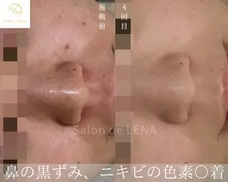 ハーブピーリング・毛穴ケア専門サロンSalon de LENA 栄店所属・ハーブピーリング専門 サロンドレナ　白藤のエステ・リラクイメージ