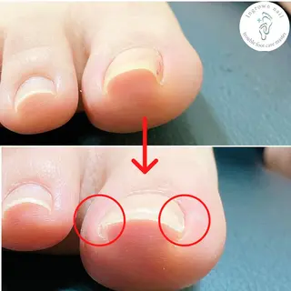 ネイル 深爪・巻き爪 専門サンセリテのネイルデザイン