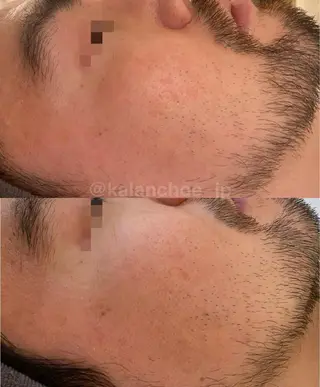 肌質改善 KALANCHOEのエステ・リラクイメージ