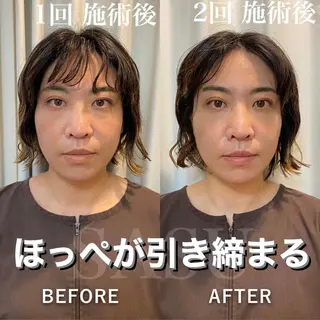 メンズ アイブロウ 即小顔♥️美容鍼× ハーブピーリングのその他イメージ