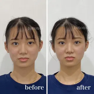はり灸サロン　totonoi所属・筋膜リリース 小顔美容鍼のエステ・リラクイメージ