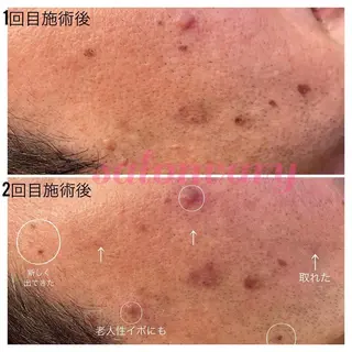 【ニキビ/肌管理】 salon varyのエステ・リラクイメージ