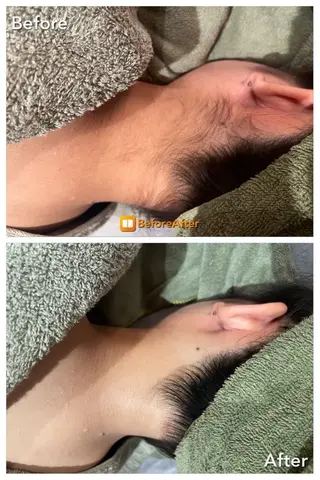 Meupニキビ専門店 背中/ハーブ/ララのその他イメージ