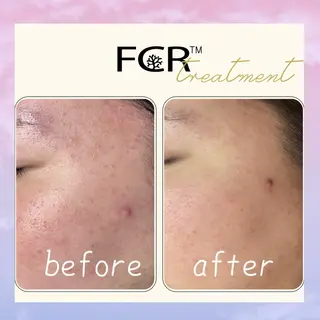 肌質改善Charme coco  みさのエステ・リラクイメージ