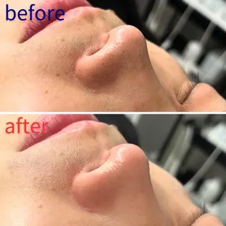 毛穴洗浄特化🫧 オオツカのエステ・リラクイメージ