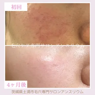 毛穴ケア専門サロンアンスリウム所属・茨城土浦 つくば毛穴 ケア専門サロンのエステ・リラクイメージ