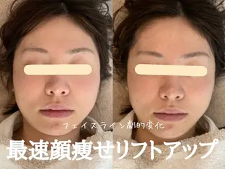 最速小顔・肌質管理 ❣️エスポワールのエステ・リラクイメージ