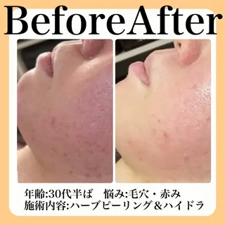 毛穴・たるみ･ニキビケア専門サロンsui所属・sui【スイ】 ARISAのエステ・リラクイメージ