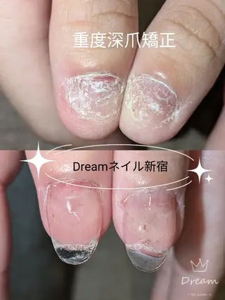 ネイル ネイリストゆか💅 長さだし、深爪矯正のネイルデザイン