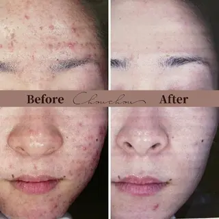 beauty & health salon Chou chou所属・ニキビ・毛穴🌿肌を 育てるララピール✨のエステ・リラクイメージ