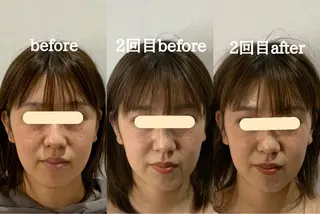 最速小顔・肌質管理 ❣️エスポワールのエステ・リラクイメージ