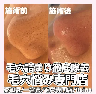 Reine BeautySalon所属・毛穴/シミ肝斑/脱毛 横山梨里のエステ・リラクイメージ
